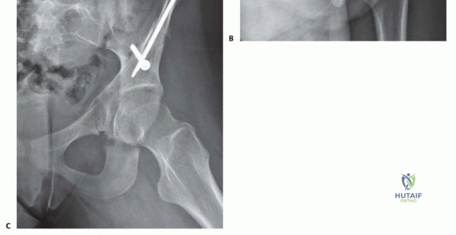 صورة طبية: استعادة صحة مفصل الفخذ جراحة قطع العظم الحوضي لعلاج خلل التنسج الحُقّي في صنعاء