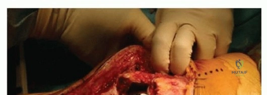 صورة توضيحية لـ تمزق وتر الرضفة بعد جراحة الركبة الصناعية المراجعة: حلول العلاج والتعافي مع الأستاذ الدكتور محمد هطيف