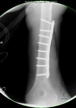 صورة طبية: دليل شامل لكسور وإصابات الجهاز الحركي: رعاية متقدمة في صنعاء مع الأستاذ الدكتور محمد هطيف