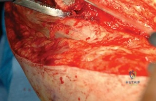 صورة طبية: مراجعة جذع الفخذ عبر النهج الخلفي: حلول متقدمة لنتائج أفضل مع الأستاذ الدكتور محمد هطيف