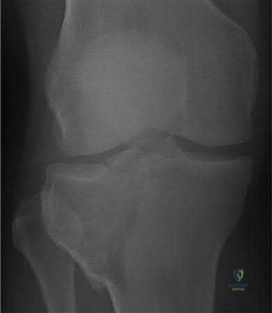 صورة طبية: دليل شامل لكسور وإصابات الجهاز الحركي: رعاية متقدمة في صنعاء مع الأستاذ الدكتور محمد هطيف
