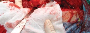 صورة طبية: استبدال مفصل الورك الكلي الناجح في خلل التنسج النمائي للورك: دليل شامل من الأستاذ الدكتور محمد هطيف