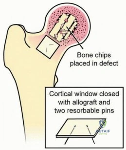 Illustration 7 for Head-Sparing for Osteonecrosis of the Femoral: Preserve Your Hip