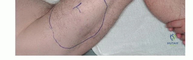 صورة طبية: استئصال ساركوما العضلة الرباعية مع الحفاظ على الطرف: دليل شامل للمرضى مع الأستاذ الدكتور محمد هطيف في صنعاء