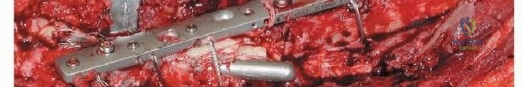 صورة توضيحية لـ إنقاذ الأطراف: أحدث التطورات في استبدال الجزء العلوي من عظم الفخذ