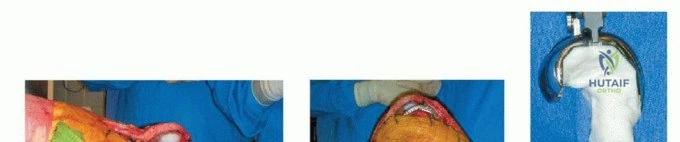 صورة طبية: تصلب مفصل الركبة بعد جراحة المراجعة: الأسباب، التشخيص، والعلاج الأمثل مع الأستاذ الدكتور محمد هطيف في صنعاء