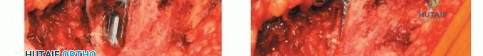 صورة طبية: استبدال مفصل الورك بدون أسمنت: استعادة الحركة والثبات في صنعاء مع الأستاذ الدكتور محمد هطيف