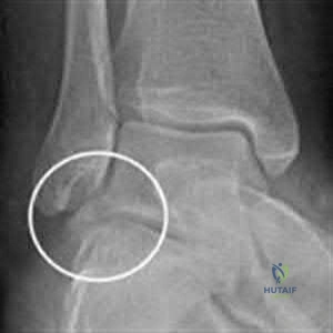 صورة طبية: دليل شامل لكسور وإصابات الجهاز الحركي: رعاية متقدمة في صنعاء مع الأستاذ الدكتور محمد هطيف