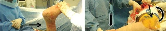 صورة طبية: إتقان توازن الأنسجة الرخوة لمفصل ورك صناعي مثالي: دليل شامل للمرضى مع الأستاذ الدكتور محمد هطيف