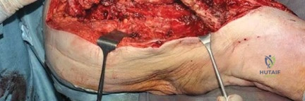 صورة توضيحية لـ عدم استقرار الكتف متعدد الاتجاهات: دليل شامل للتشخيص والعلاج والتعافي مع الأستاذ الدكتور محمد هطيف