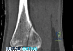 صورة توضيحية لـ كسر قصبة الساق الممتد إلى مفصل الكاحل (البلافون): أسرار العلاج بالمسمار النخاعي مع الأستاذ الدكتور محمد هطيف