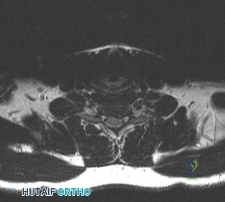 صورة شعاعية توضح انزلاقًا غضروفيًا في الفقرات العنقية C6-7