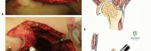 صورة توضيحية لـ جراحة نقائل الحوض: حل شامل لآلام العظام واستعادة الحركة مع الأستاذ الدكتور محمد هطيف