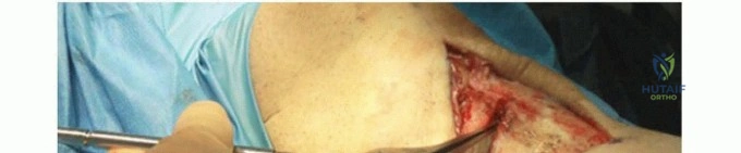 صورة طبية: قطع عظم الظنبوب العالي: إعادة محاذاة الركبة لتخفيف دائم لآلامها مع الأستاذ الدكتور محمد هطيف
