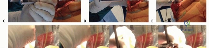 صورة طبية: جراحة مراجعة مفصل الركبة: تقنيات آمنة لإزالة المكونات الثابتة واستعادة الحركة مع الأستاذ الدكتور محمد هطيف في صنعاء