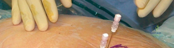 صورة طبية: منظار مفصل الفخذ: حل متقدم لآلام الورك ومشاكله المعقدة في صنعاء