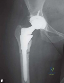 صورة طبية: استبدال مفصل الورك الكلي الناجح في خلل التنسج النمائي للورك: دليل شامل من الأستاذ الدكتور محمد هطيف