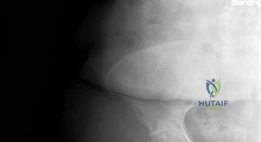 صورة توضيحية لـ جراحة استبدال مفصل الورك بالمدخل الأمامي المباشر بدون طاولة شد: دليل شامل للمرضى في صنعاء