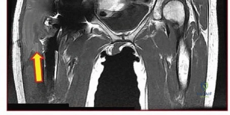 صورة طبية: اختيار أسطح مفصل الورك الاصطناعي الأنسب لحالتك: دليل شامل من الأستاذ الدكتور محمد هطيف في صنعاء