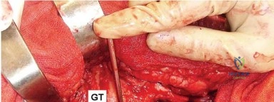 صورة توضيحية لـ إتقان توازن الأنسجة الرخوة لمفصل ورك صناعي مثالي: دليل شامل للمرضى مع الأستاذ الدكتور محمد هطيف