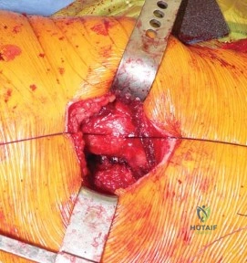 صورة طبية: استبدال مفصل الورك الكلي في العيادات الخارجية: دليل شامل من الأستاذ الدكتور محمد هطيف في صنعاء