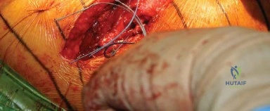 صورة طبية: المدخل الخلفي الجانبي لجراحة استبدال مفصل الورك الكلي: دليل شامل للمرضى في صنعاء مع الأستاذ الدكتور محمد هطيف