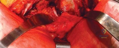 صورة طبية: النهج الخلفي الجانبي المتقدم: تحقيق أفضل النتائج في جراحة استبدال مفصل الورك الكلي مع الأستاذ الدكتور محمد هطيف في صنعاء