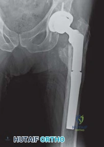 صورة طبية: استبدال مفصل الورك لإنقاذ حالات فشل تثبيت كسور الورك: حل فعال لاستعادة الحركة