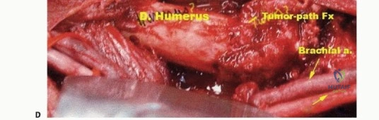 صورة طبية: استئصال الجزء البعيد من عظم العضد: تقنيات آمنة للحفاظ على الطرف في صنعاء مع الأستاذ الدكتور محمد هطيف