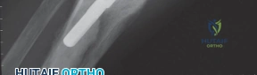 جراح يقوم بإعادة بناء الجهاز الباسط