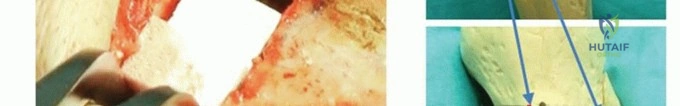 صورة طبية: قطع عظم الظنبوب العالي: إعادة محاذاة الركبة لتخفيف دائم لآلامها مع الأستاذ الدكتور محمد هطيف