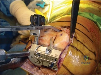 خبرة الأستاذ الدكتور محمد هطيف في جراحة المفاصل وتغيير الركبة