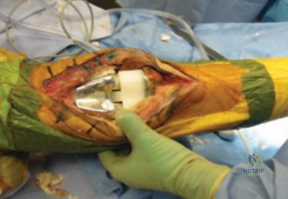 صورة توضيحية لـ جذوع الركبة غير المثبتة بالأسمنت في جراحات المراجعة: دليل شامل للمرضى مع الأستاذ الدكتور محمد هطيف