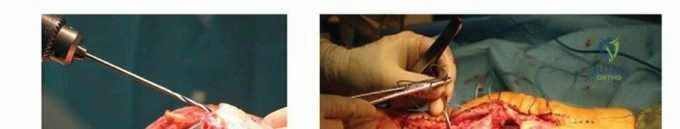 صورة توضيحية لـ تمزق وتر الرضفة بعد جراحة الركبة الصناعية المراجعة: حلول العلاج والتعافي مع الأستاذ الدكتور محمد هطيف