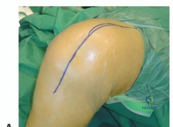 صورة توضيحية لـ قطع الحدبة الظنبوبية: دليل شامل لمرضى تبديل الركبة المراجع مع الأستاذ الدكتور محمد هطيف في صنعاء