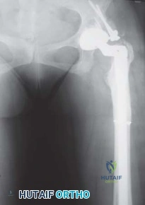 صورة طبية: استبدال مفصل الورك الكلي الناجح في خلل التنسج النمائي للورك: دليل شامل من الأستاذ الدكتور محمد هطيف