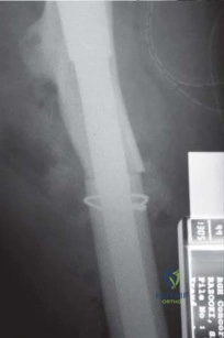 صورة طبية: استبدال مفصل الورك الكلي الناجح في خلل التنسج النمائي للورك: دليل شامل من الأستاذ الدكتور محمد هطيف