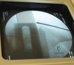 صورة طبية: تثبيت مفصل الركبة بالمسمار النخاعي: حل فعال لمشاكل المفاصل الصناعية الفاشلة