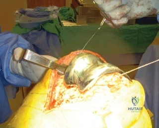 صورة توضيحية لـ إزالة الغرسات العظمية الثابتة بإحكام: دليل شامل لمرضى جراحة المفاصل الصناعية