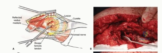صورة طبية: النقائل العظمية الفخذية: دليل شامل للعلاج واستعادة الوظيفة مع الأستاذ الدكتور محمد هطيف في صنعاء