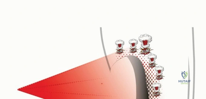 صورة توضيحية لـ الاستئصال الموجه لأورام الجهاز العضلي الهيكلي: نهج أكثر أمانًا وفعالية مع الأستاذ الدكتور محمد هطيف