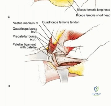 صورة طبية: استئصال ساركوما العضلة الرباعية مع الحفاظ على الطرف: دليل شامل للمرضى مع الأستاذ الدكتور محمد هطيف في صنعاء