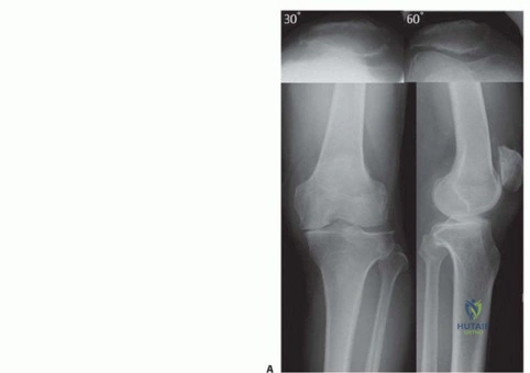 صورة طبية: قطع عظم الظنبوب العالي: إعادة محاذاة الركبة لتخفيف دائم لآلامها مع الأستاذ الدكتور محمد هطيف