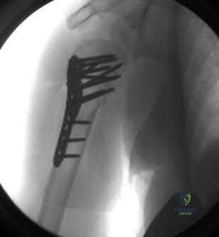 صورة طبية: دليل شامل لكسور وإصابات الجهاز الحركي: رعاية متقدمة في صنعاء مع الأستاذ الدكتور محمد هطيف