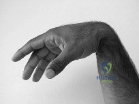 مريض يستعيد قدرته على صعود الدرج بعد الجراحة الناجحة