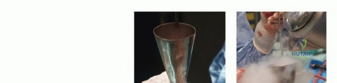 صورة توضيحية لـ تجنب الجراحة الكبرى: علاج أورام العظام بالنيتروجين السائل بتقنية الصب المباشر