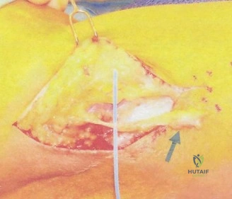 صورة طبية: آلام المرفق المعقدة: فهم وعلاج وتر الكاربوس الزندي القصير وغيرها من إصابات المرفق مع الأستاذ الدكتور محمد هطيف