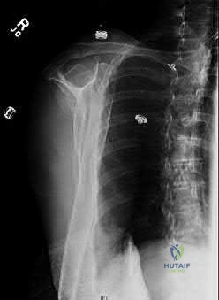 صورة طبية: دليل شامل لكسور وإصابات الجهاز الحركي: رعاية متقدمة في صنعاء مع الأستاذ الدكتور محمد هطيف