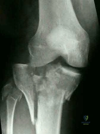 صورة طبية: دليل شامل لكسور وإصابات الجهاز الحركي: رعاية متقدمة في صنعاء مع الأستاذ الدكتور محمد هطيف