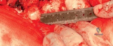 صورة طبية: المدخل الخلفي الجانبي لجراحة استبدال مفصل الورك الكلي: دليل شامل للمرضى في صنعاء مع الأستاذ الدكتور محمد هطيف
